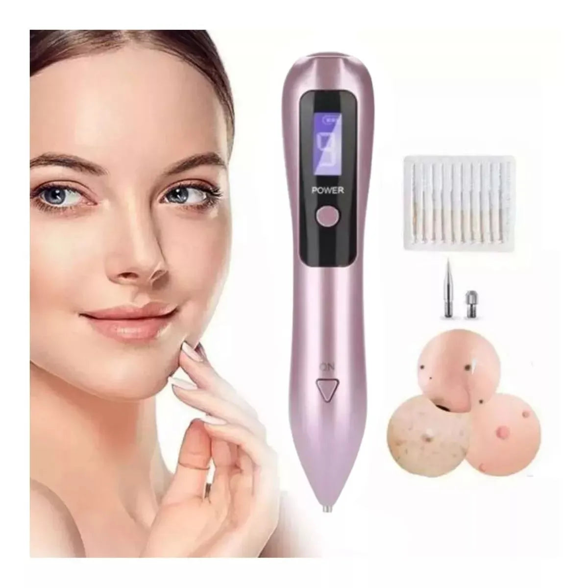 REMOVEDOR CAUTERIZADOR DE VERRUGAS Y PECAS POR PLASMA LÁSER